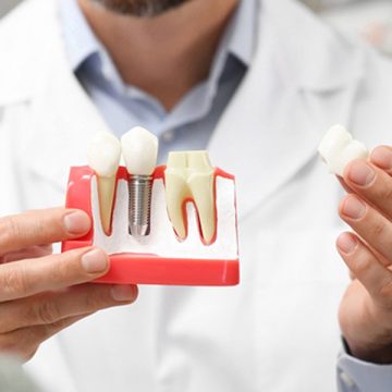 When Should I Restore My Dental Implant? A Comprehensive Guide